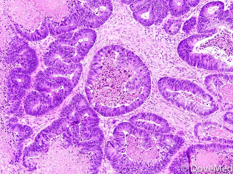 Facts about Adenocarcinoma of Cervix