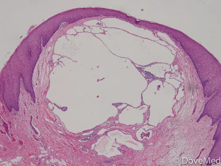 Lymphangioma of Esophagus