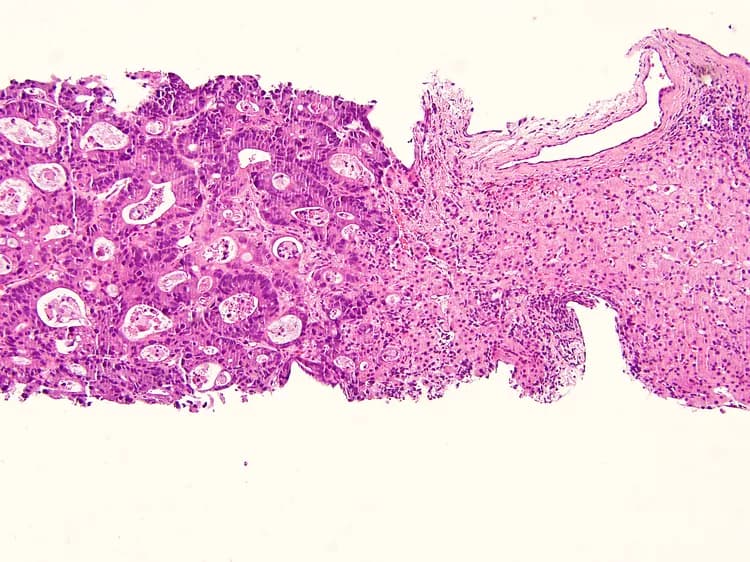 Combination Immunotherapy Could Stop Liver Cancer Growth