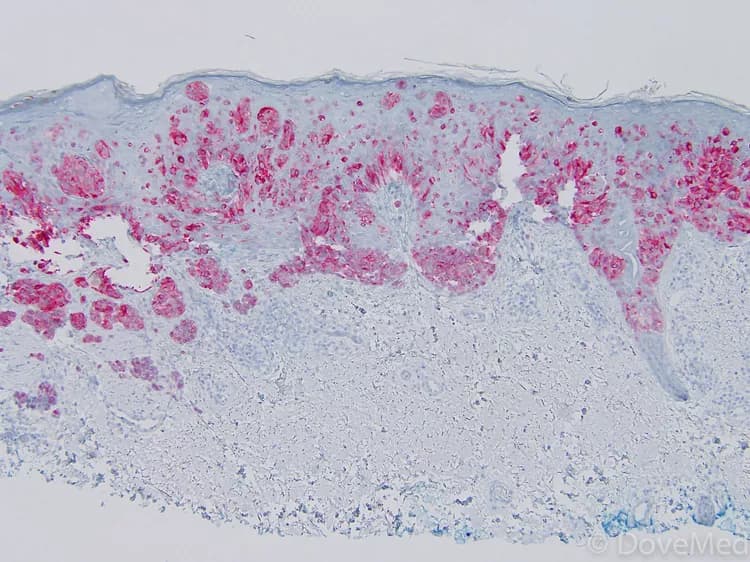 Pediatric Melanoma