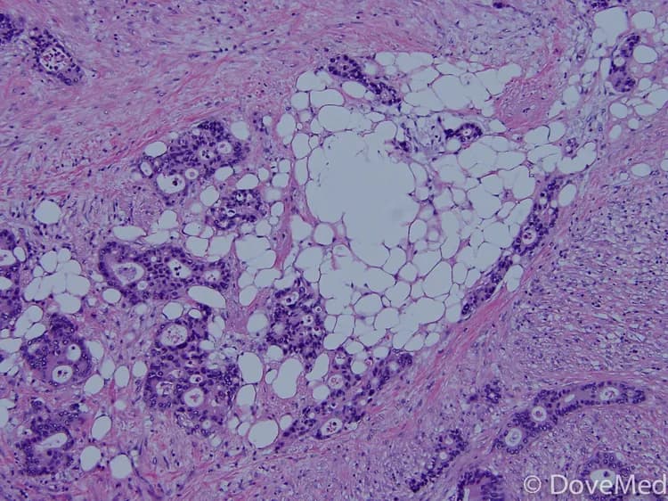 Acinar Adenocarcinoma of Lung