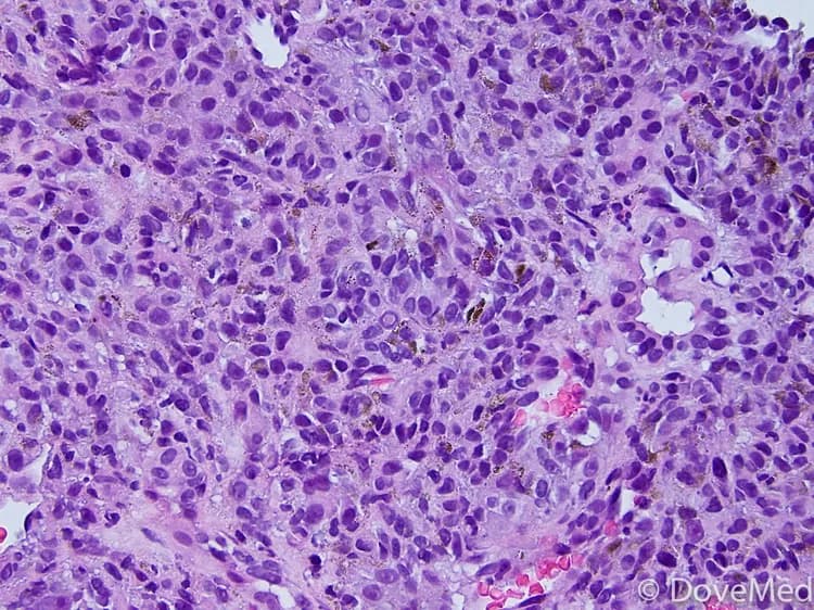Predictive Proteins: Elevated Levels Trigger Metastatic Progression Of Cancer Cells