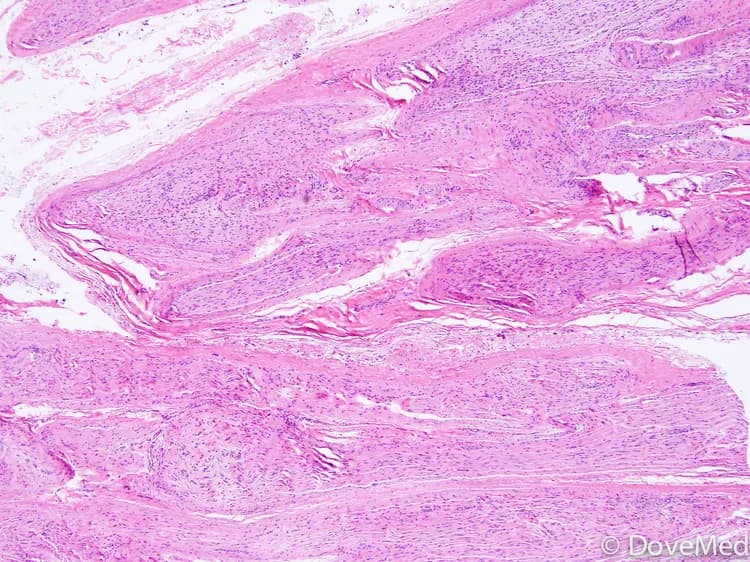 Colonic Arteriovenous Malformation