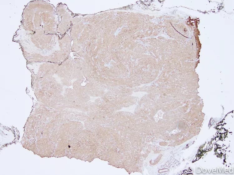 Leiomyoma of Scrotum