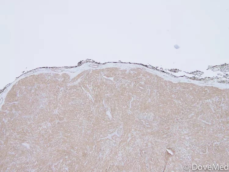 Pilar Leiomyoma