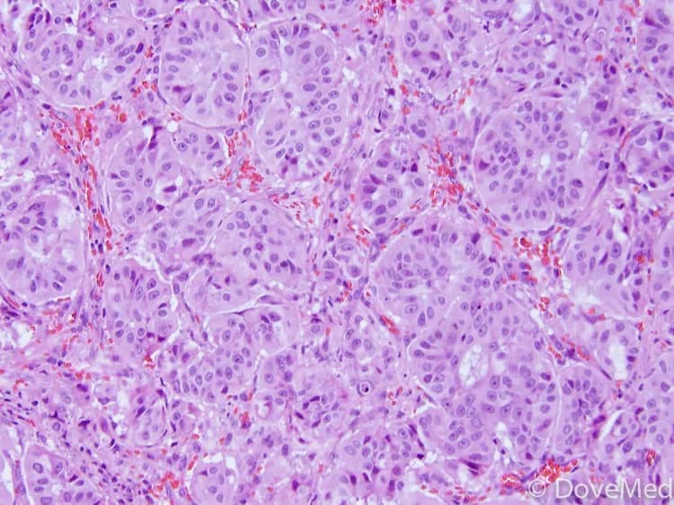 Adenocarcinoma In Situ of Lung