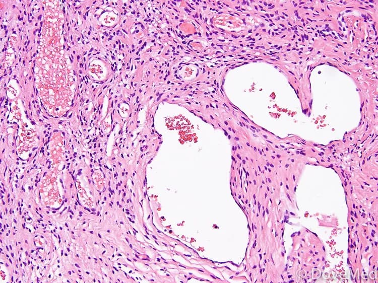 Facts about Venous Hemangioma