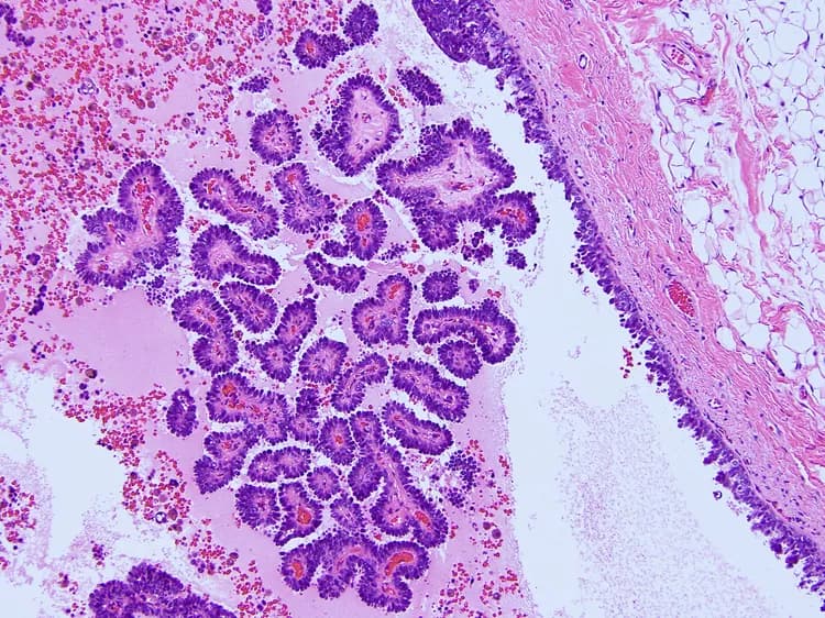 Breast Cancer Patients With Dense Breast Tissue More Likely To Develop Contralateral Disease