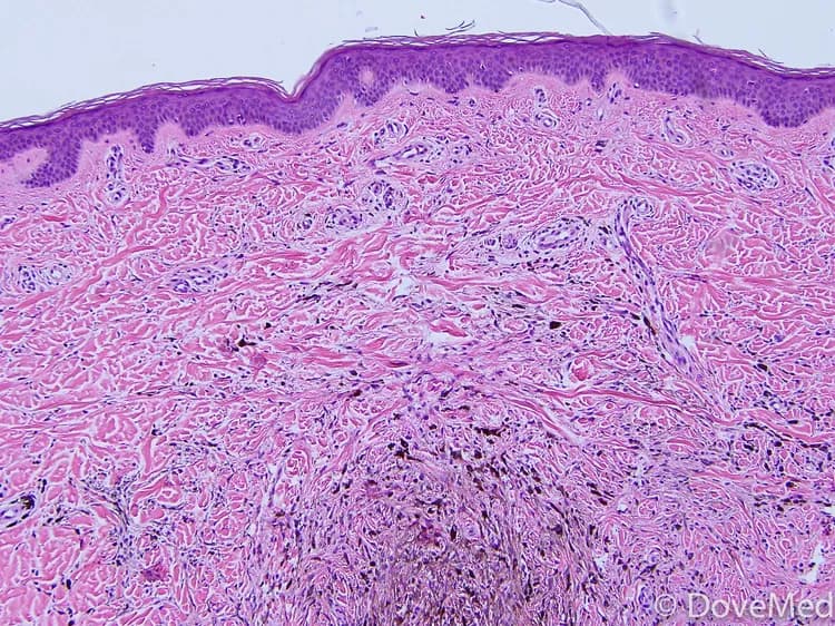 Facts about Blue Nevus