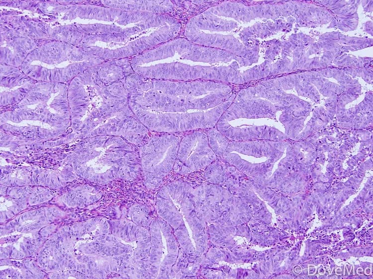 Lepidic Adenocarcinoma of Lung