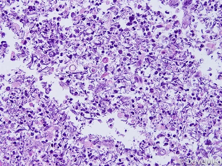 Squamous Cell Carcinoma of Esophagus