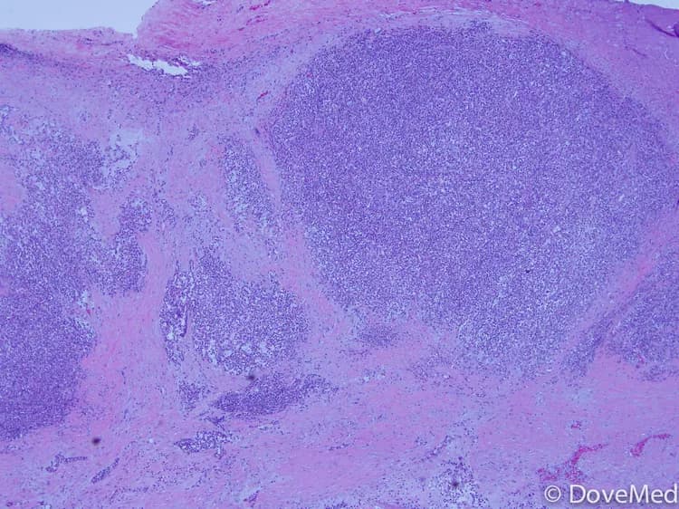 Skin Cancer: Drug Combination Could Improve Immunotherapy