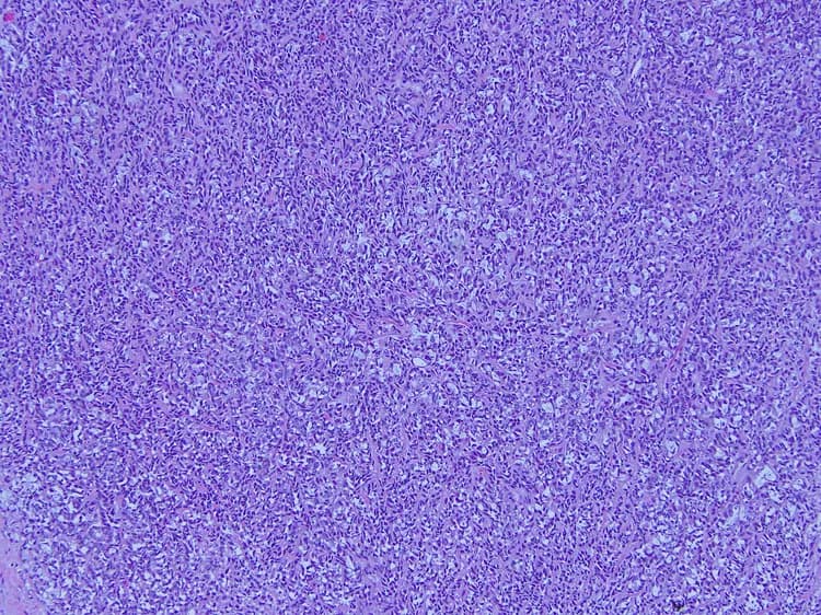 Lymphoma of Thyroid Gland