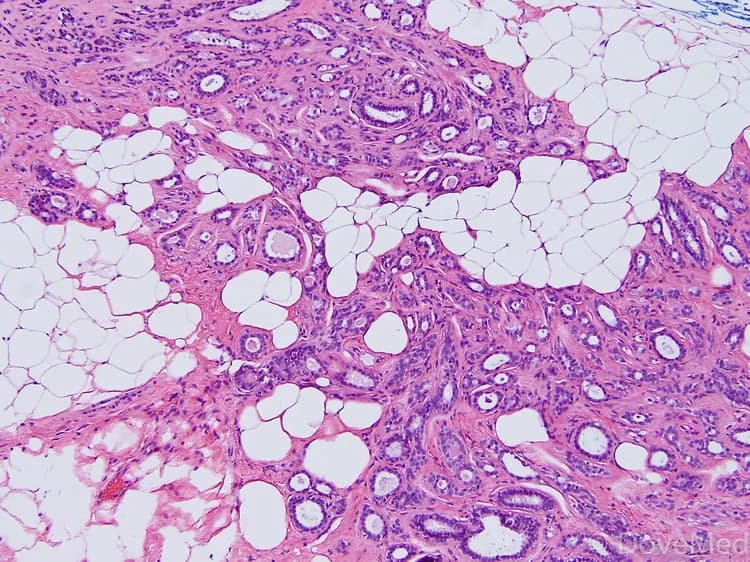 Adenosis of Breast