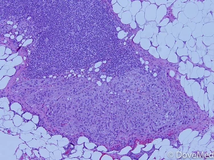 Mucosal Melanoma