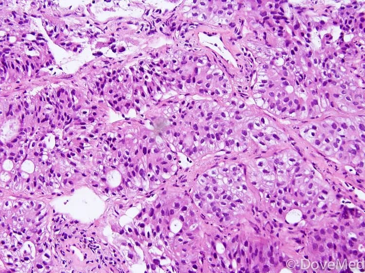 Micropapillary Adenocarcinoma of Lung