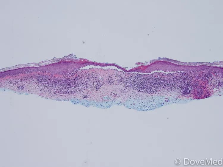 Lichen Planus