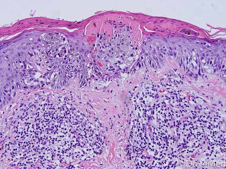 True or False? The ABCDE's of melanoma include Asymmetry, Border, Color, Diameter, and Evolving.