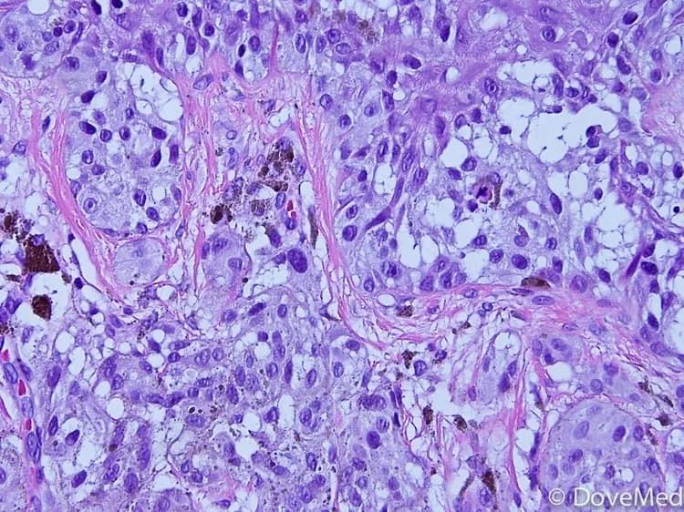 Stage IV Melanoma