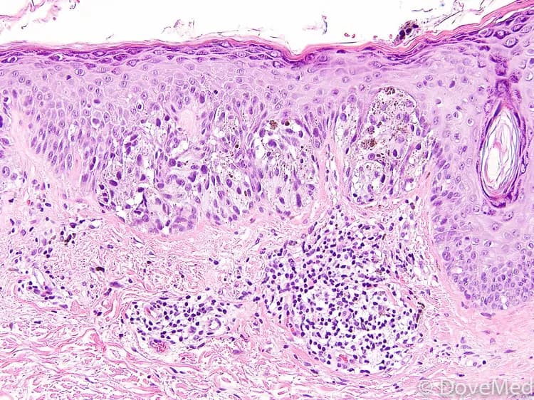 Melanoma In Situ of Skin