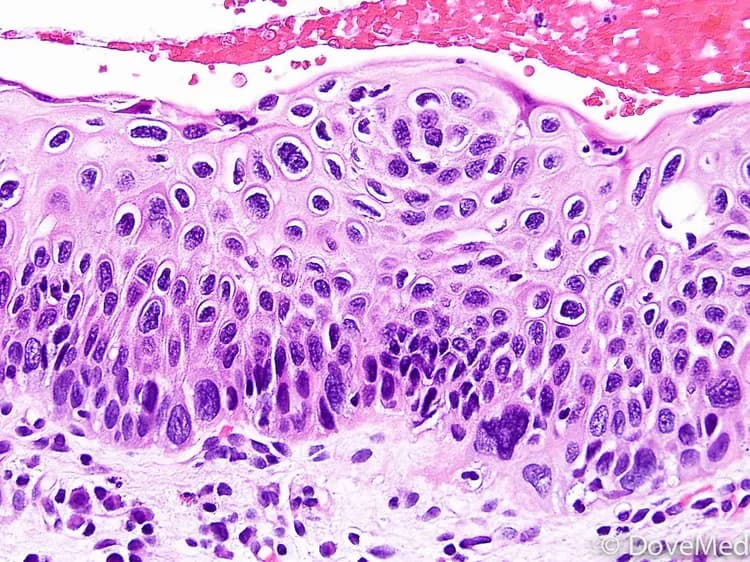 Squamous Cell Carcinoma In Situ of Vulva