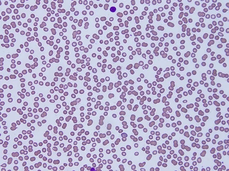 Hemoglobin Variants Blood Tests