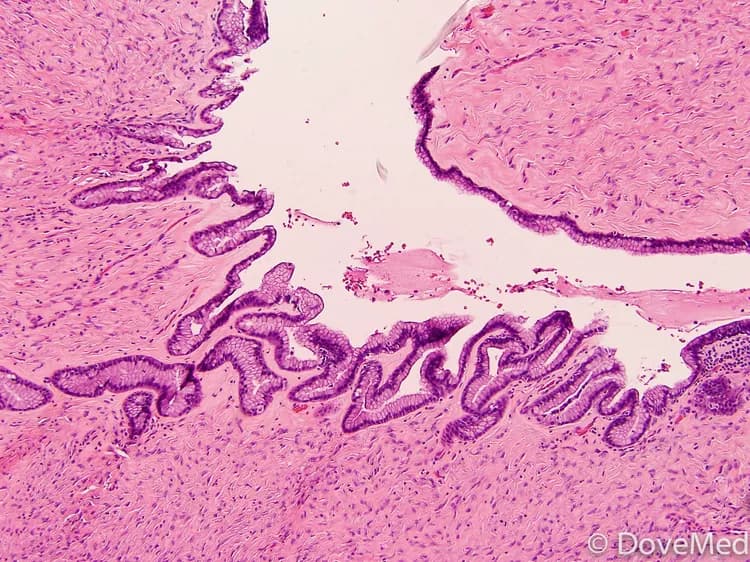 What are the treatment options for Benign Mucinous Cystadenoma of Pancreas?