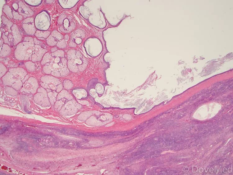 Dermoid Cyst of Ovary