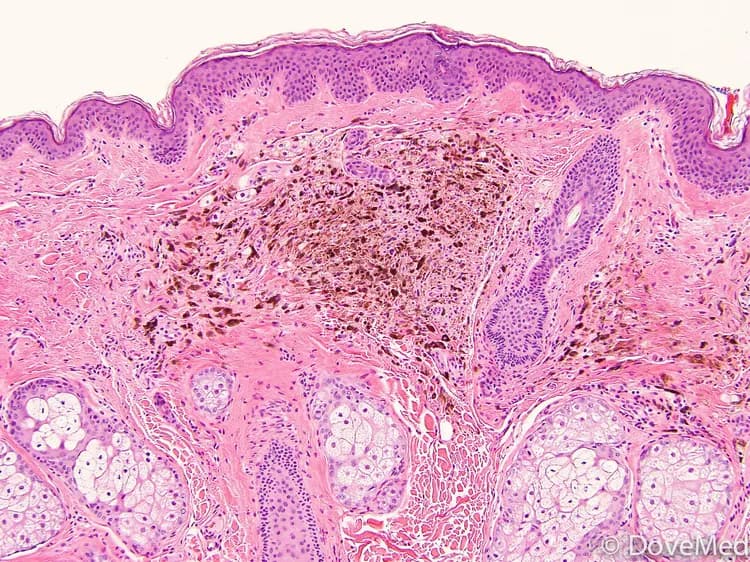 Cellular Blue Nevus