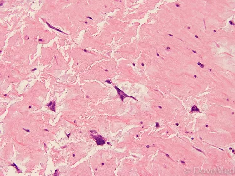 Aggressive Angiomyxoma of Vulva