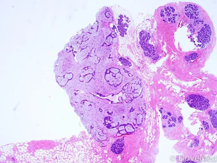 Fibroadenoma of the Breast