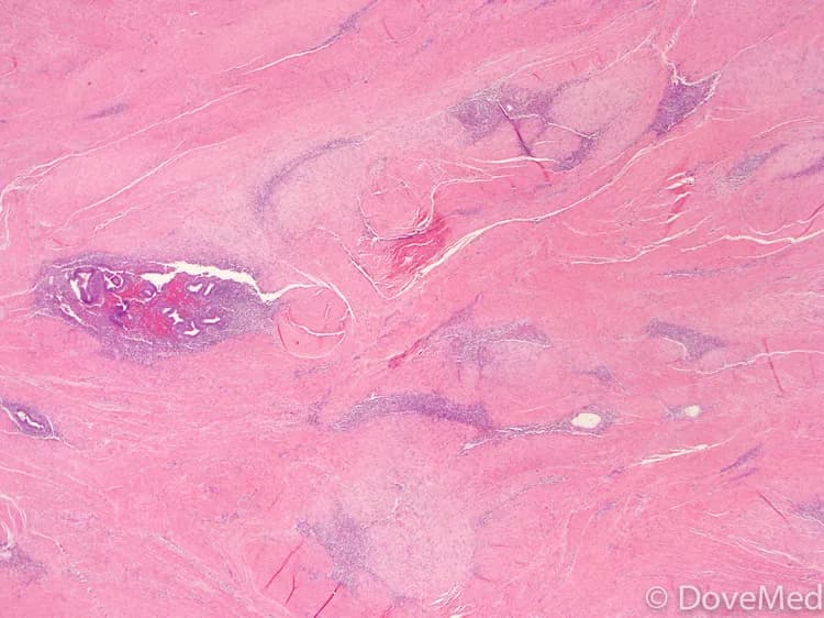 Endometriosis of Other Locations