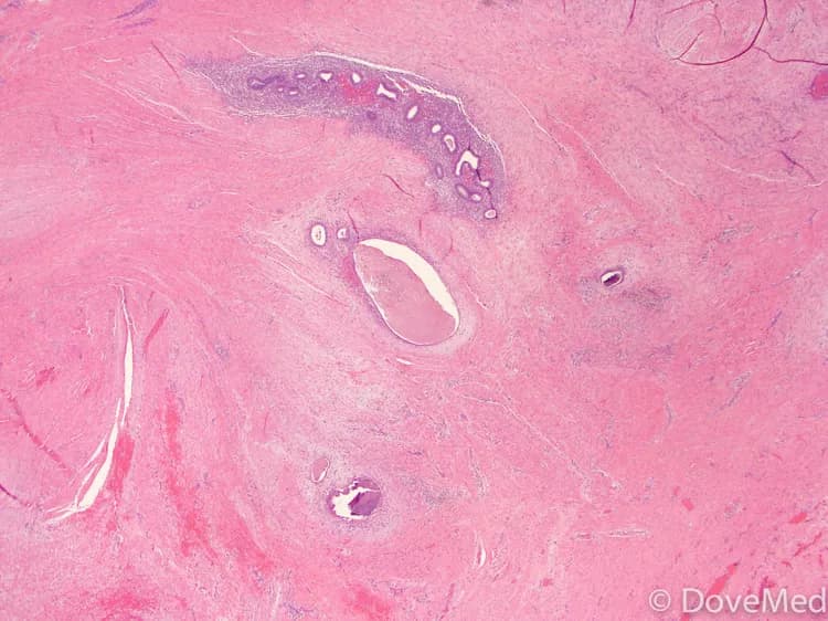 Endometriosis of Vagina