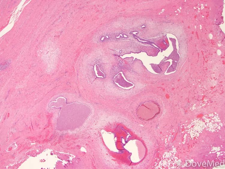 Can you access healthcare professionals in your community to manage Endometriosis of Vagina?