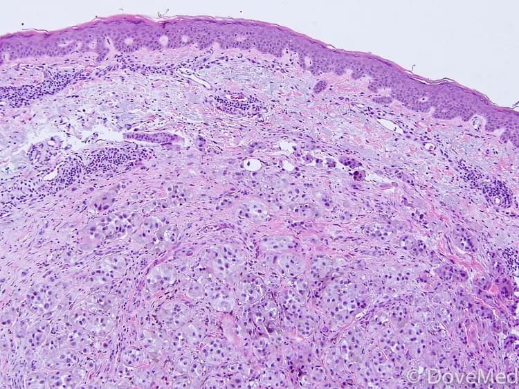Nodular Melanoma of Skin