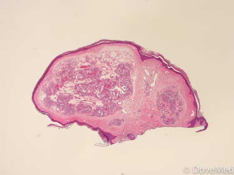 Liver Hemangioma