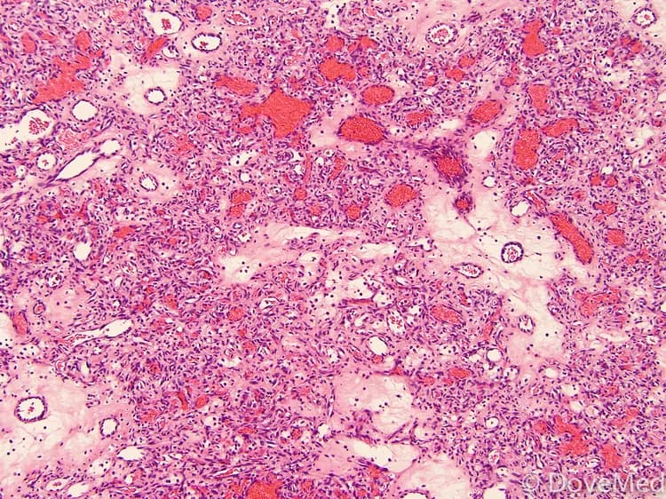 Sinusoidal Hemangioma