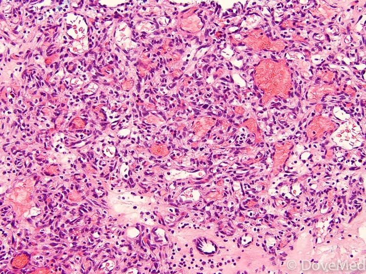 Hemangioma of Esophagus