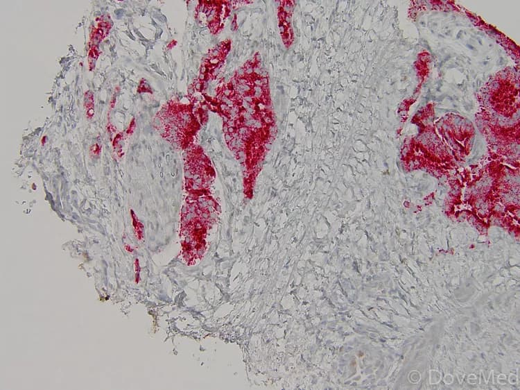 Stage III Melanoma
