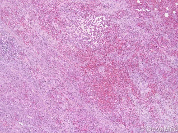 Angiosarcoma of Small Intestine
