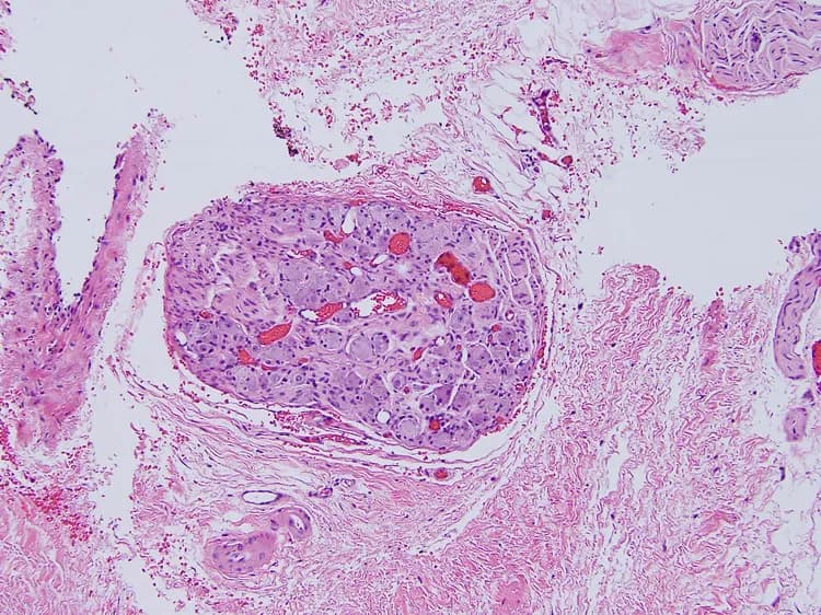 New Mechanism Of Resistance To Chemotherapy Identified