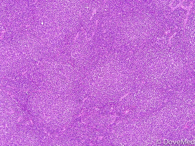 Follicular Lymphoma