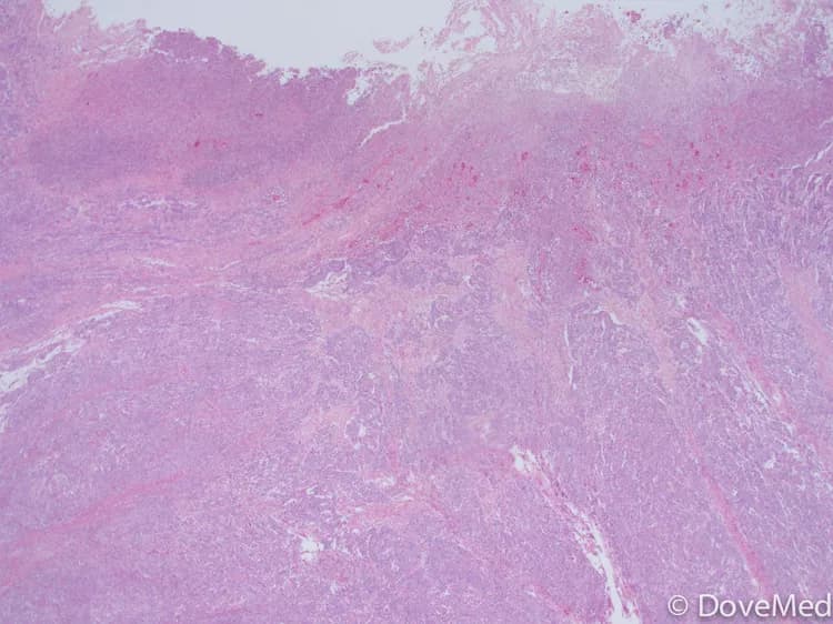 Medullary Carcinoma of Colon and Rectum