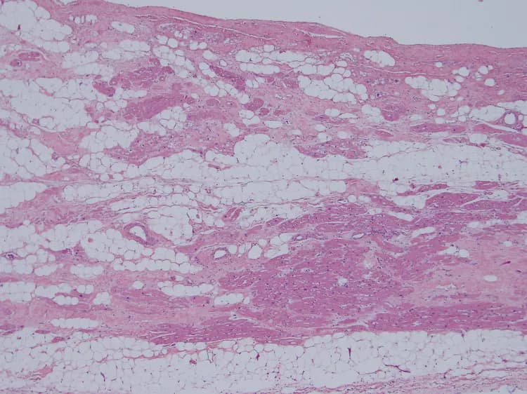 Study Links Fatty Liver, Heart Failure In Obese People