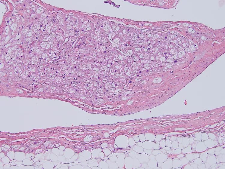 Silencing Fat Protein Improves Obesity And Blood Sugar