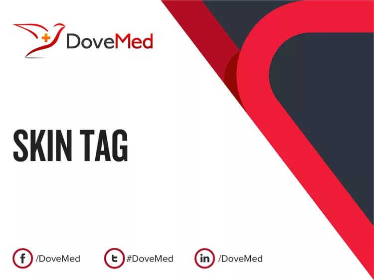 Can you access healthcare professionals in your community to manage Skin Tag?