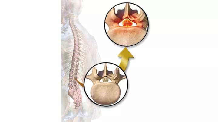 Lumbar Spinal Stenosis (Narrow Canal), Adult Spinal Disorders, Adults