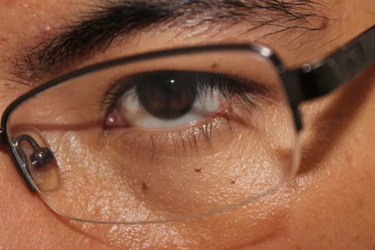 Panuveitis