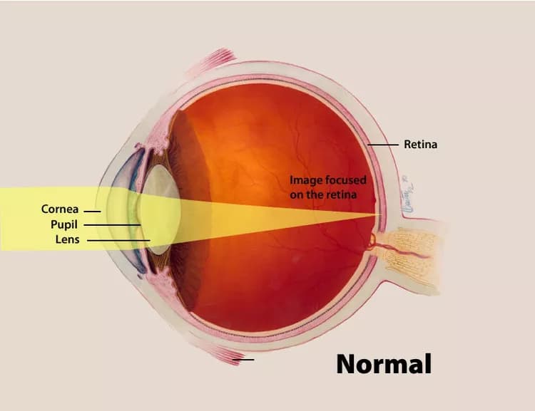 Eye Infection: A Gentle Approach Treating Microbial Keratitis