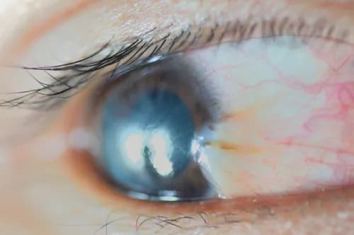 Pterygium